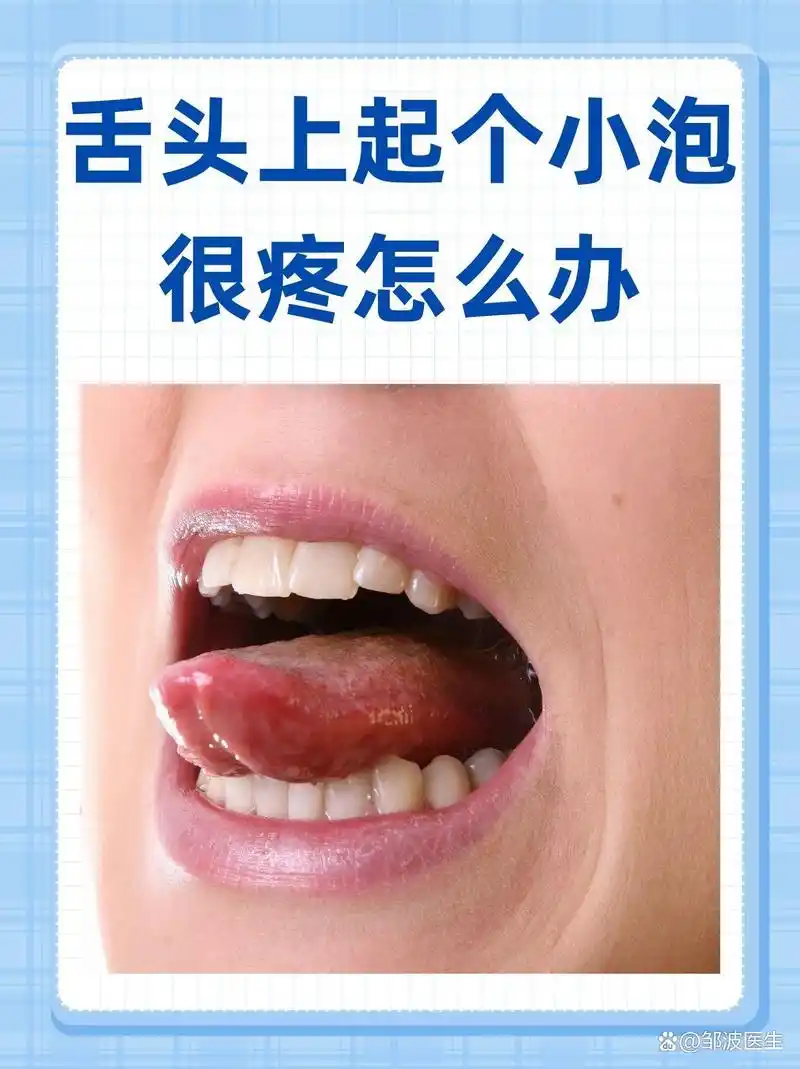 舌头上起个小泡很疼怎么办