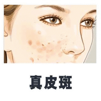 脸上总爱长斑下斑难方法你找对了吗