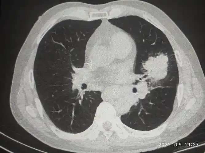 肺结节肺癌几问几答