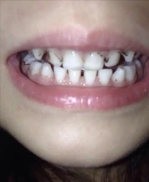 宝宝牙齿色素沉着怎么处理