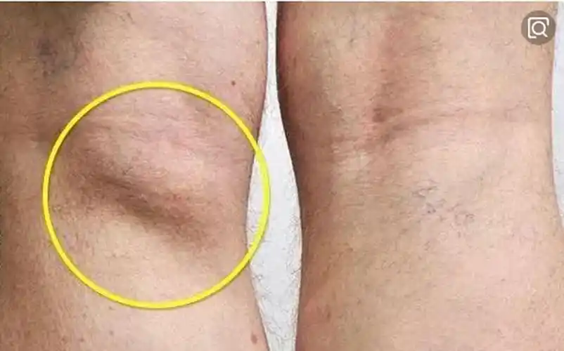 膝盖后面查出腘窝囊肿?不要太担心,骨科医生教给你该怎么办. - 知乎