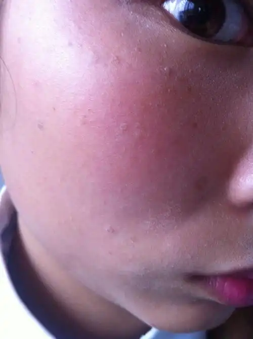 脸上最近长了很多斑点,还有突起脱皮,是不是藓啊?