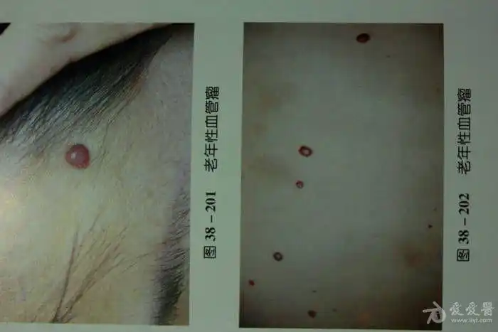 中年男士躯干部的红色丘疹樱桃状血管瘤