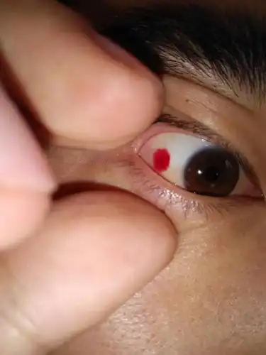 眼睛里突然出现血块怎么回事,一点感觉都没有,怎么解决