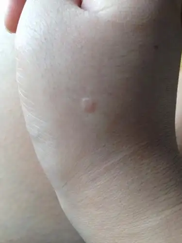 请问这是扁平疣吗?