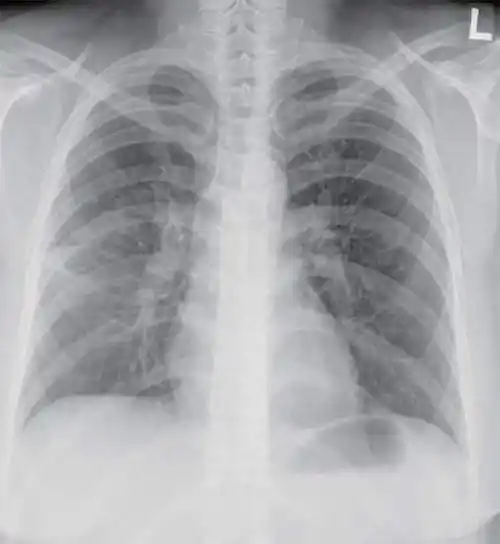 肺炎支原体感染伪膜性气管炎一例