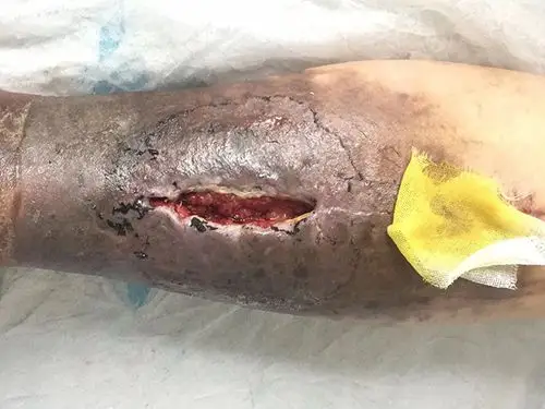 慢性化脓性骨髓炎手术后复发了怎么办