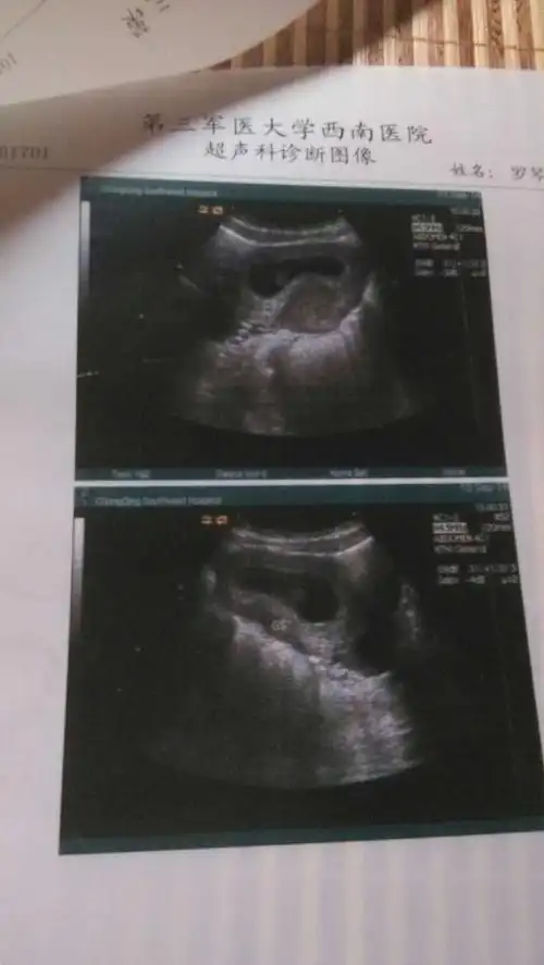 茄子状的孕囊是男孩子?