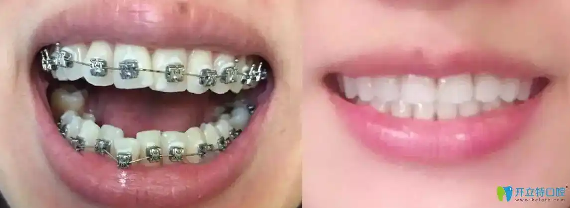 24岁正畸不算晚聊聊我在西安画美口腔做牙齿矫正那些事