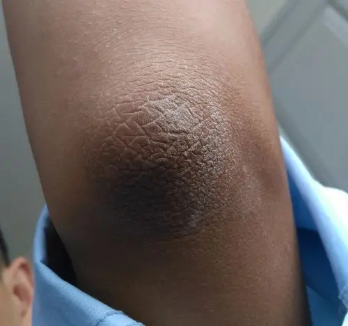 胳膊肘皮肤变成这样怎么回事?