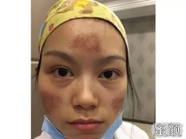 果酸换肤前后对比案例,痘痘脸立马变清爽!-爱美美容优惠