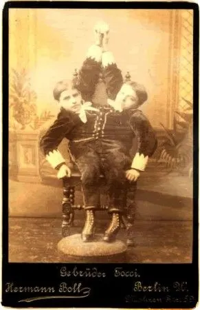 揭秘最出名的20对连体人