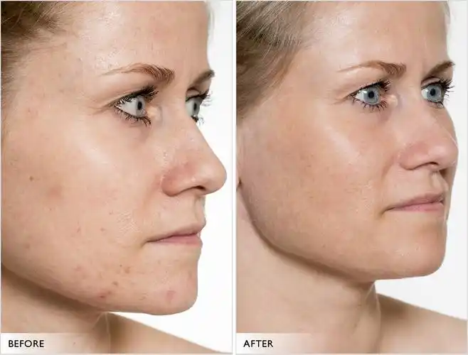 10:03:22before/after - serum038对比/肌肤问题-nnnyy