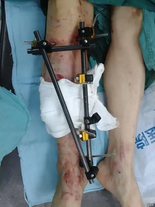 胫骨外固定支架请大家指正