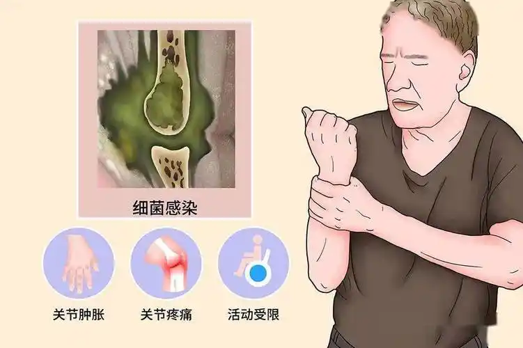 化脓性关节炎
