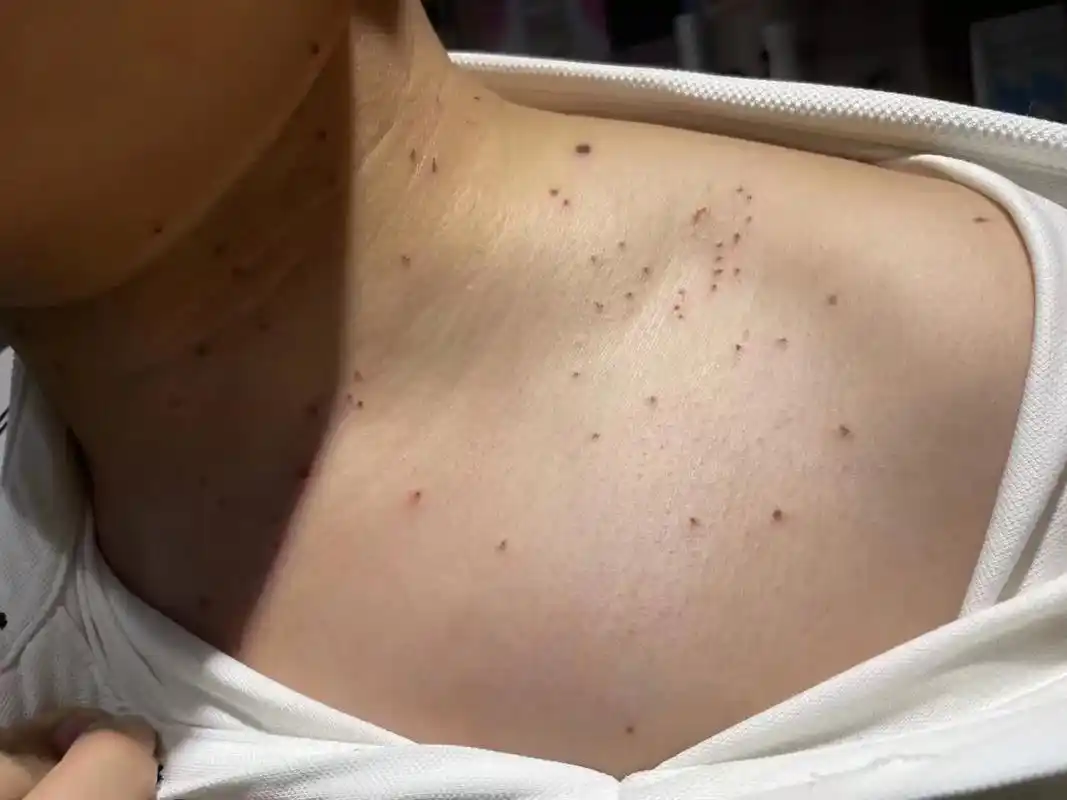 扁平疣是由人乳头瘤病毒(hpv)感染皮肤所致,是疣的一种