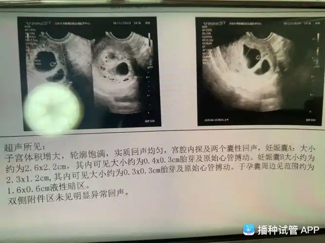 [试管婴儿]孕7 3,双胞胎,其中一个孕囊