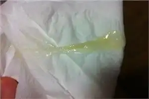 怀孕初期分泌物图片怀孕初期分泌物图片怀孕初期分泌物图片正常的白带