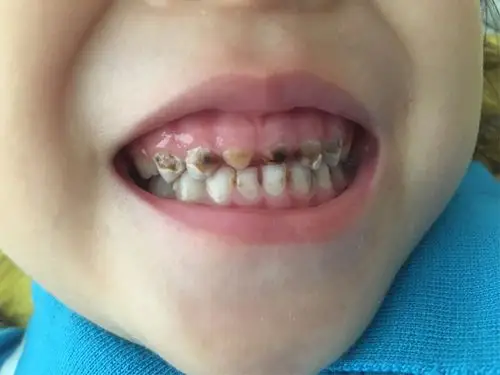 牙齿变黑,牙齿上的洞洞是怎么产生的?