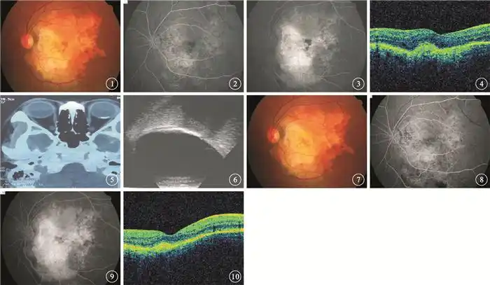 玻璃体腔注射雷珠单抗治疗脉络膜骨瘤继发脉络膜新生血管一例