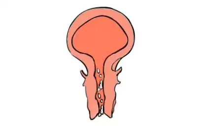 女性尿道口翻开有白色豆腐渣图片_妙手医生