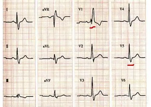 肺栓塞的心电图诊断