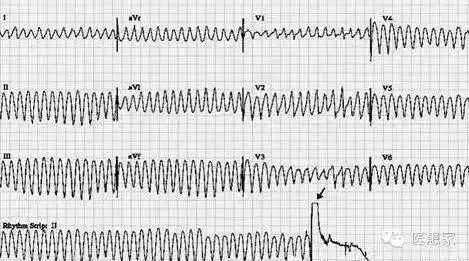 一文教你识别致命的心电图