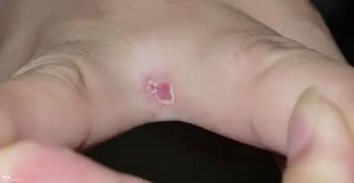 什么意思,今夏居然烂手指窝了?难道我身体湿气太大