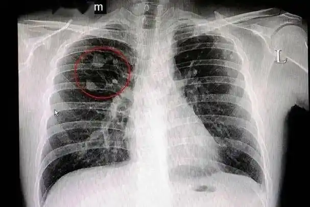 29岁女子无症状确诊肺癌!体检查出肺结节怎么办?_进行_肺部_复查