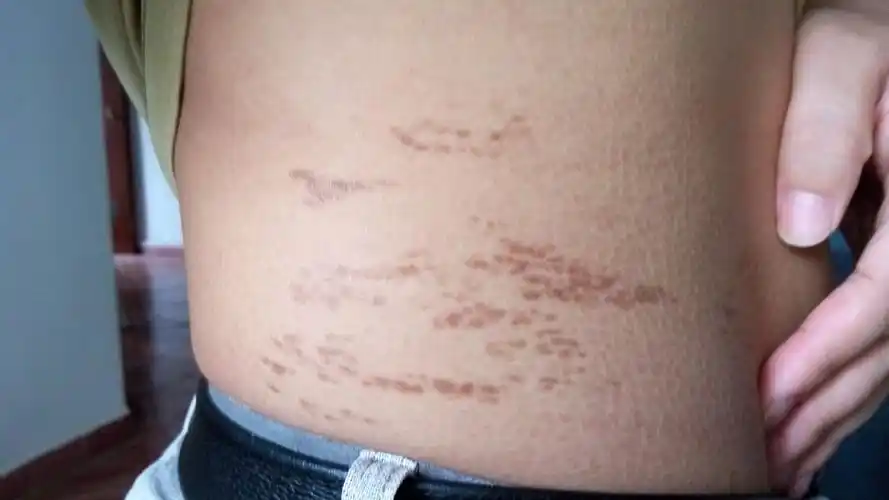 肚腩上黑褐色斑点