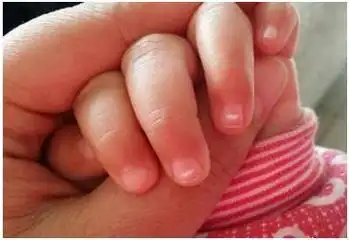 孩子这些症状,警惕患有蛔虫病!