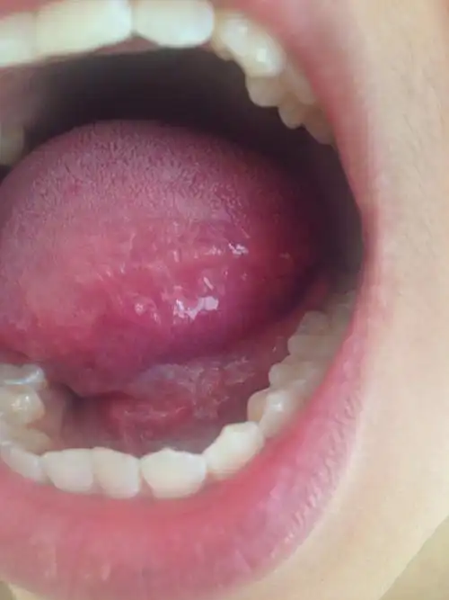 有点像肉芽 在网上查像尖锐湿疣 说会有异物感 之后就感觉喉咙里有异