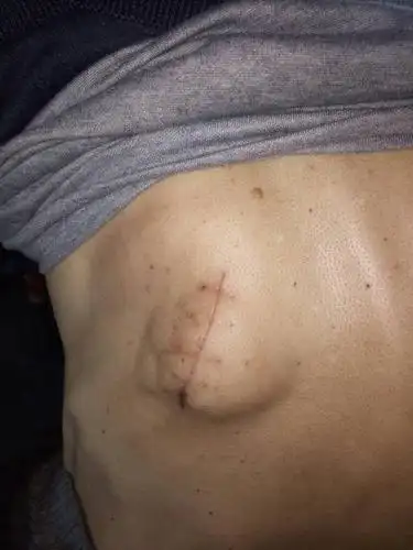 恶性纤维瘤能治好吗?