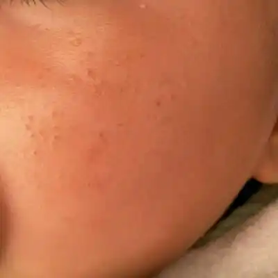 宝妈们,有没有像我家宝宝这样脸上涨的好像是脂肪粒似的小疙瘩,从月子