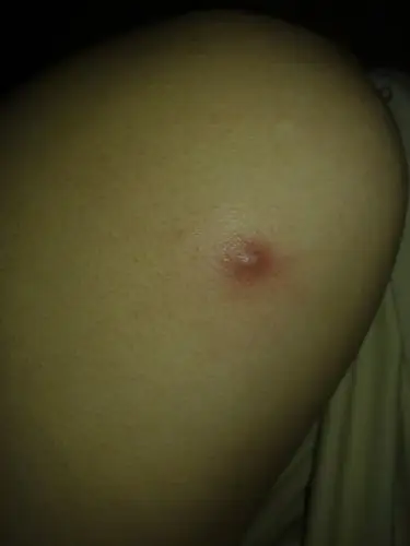 胳膊上长个大红疙瘩很痛.怎么办?