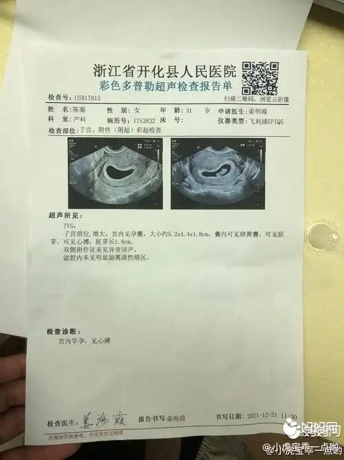 都说男孩女孩看孕囊我这个老去典型的茄子形状呀大家帮忙看下