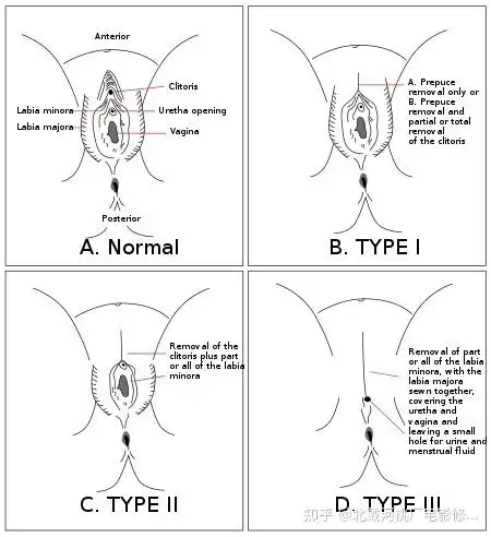 2022年了,割礼依旧存在 - 知乎