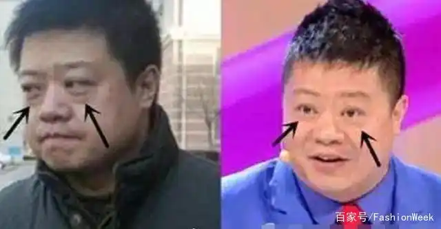 郭京飞割完眼袋后形象骤变!黑西装造型太有范,对比早前判若两人