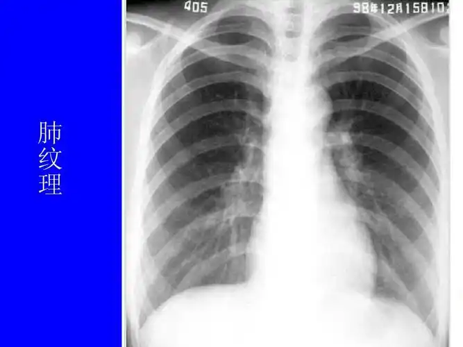 肺部正常和x线异常表现ppt
