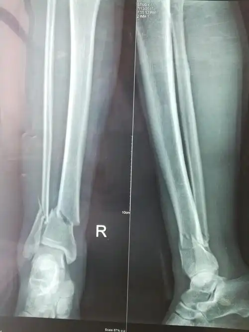 右胫腓骨远端骨折