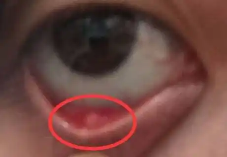 急,在线等,我长了针眼,男朋友要和我闹分手怎么办