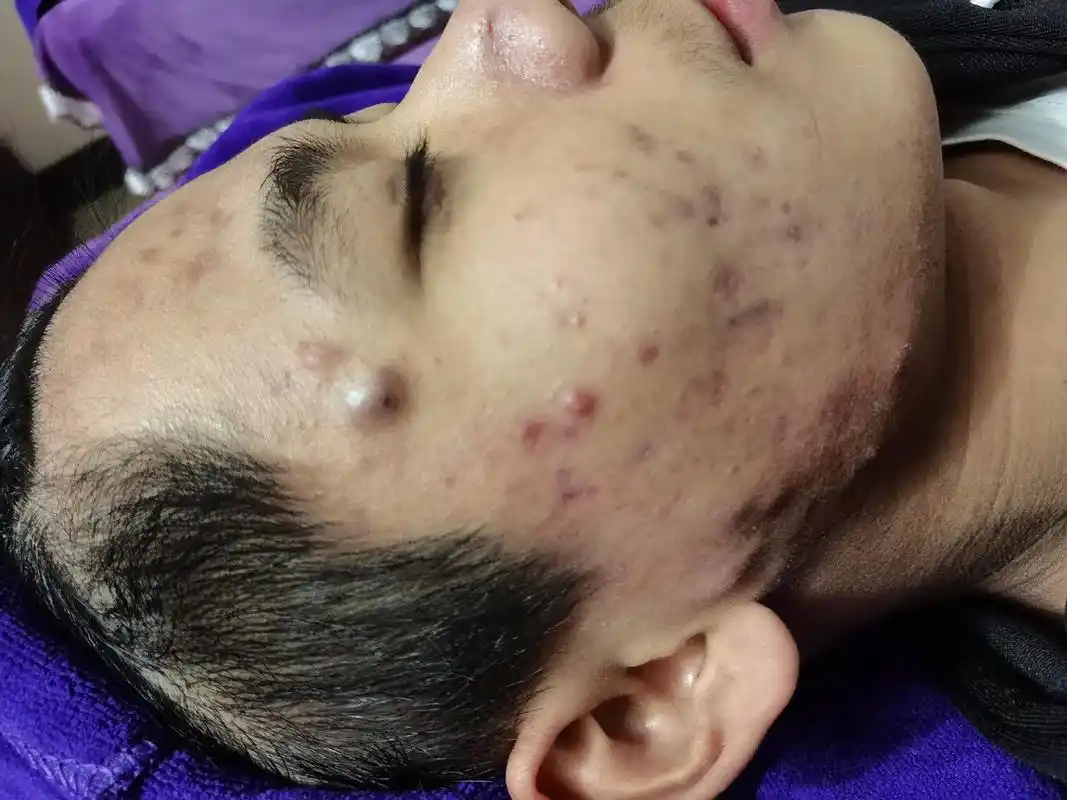 痘痘肌由于皮脂腺在性激素影响下分泌过多皮脂,阻塞毛囊口造成局 - 抖