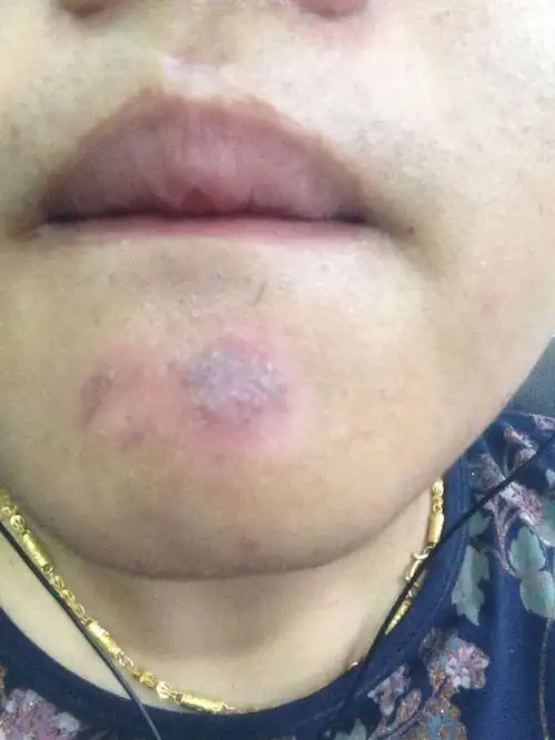 直到结痂完全脱落.