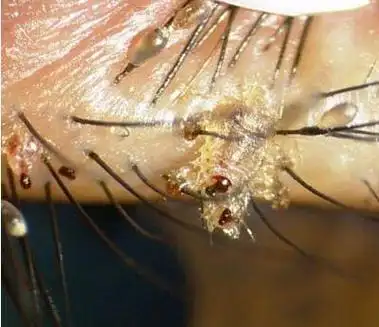 阴虱病症状图片