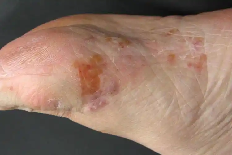 脚上皮肤病识别图