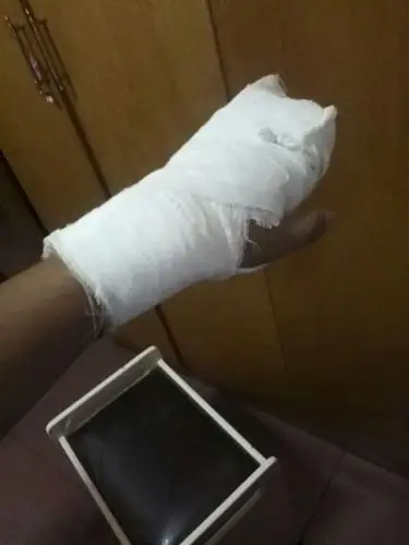 手骨折图片 (15)_有来医生