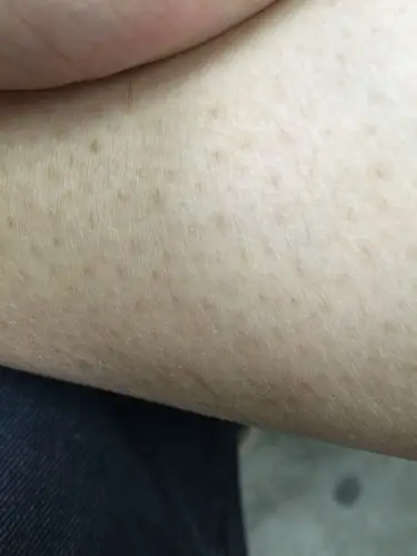 腿上很多这种黑点,看起来很奇怪.不知道是什么病么.求解.