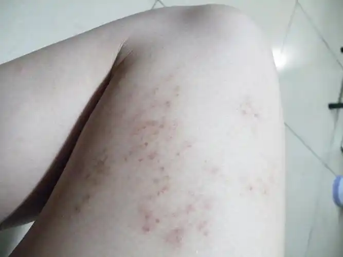 右腿内侧出现红色点状的血斑问题,日久会扩散,方向是由上到下,已经