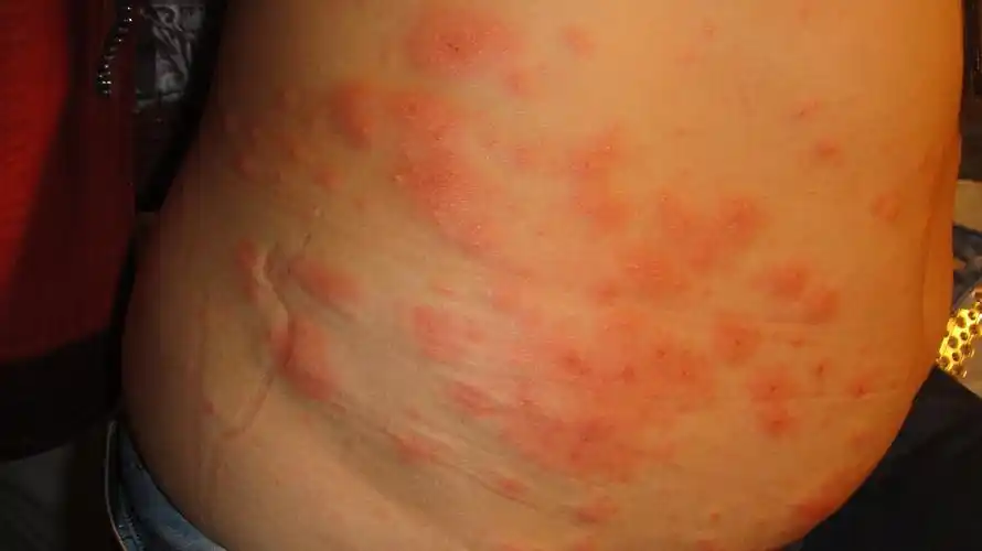 看图诊病-《春季皮肤病病例征集》