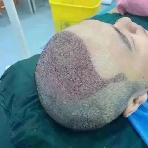 男士植发前后对比